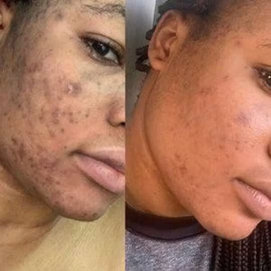 Brightening Pads with Turmeric and Kojic Acid