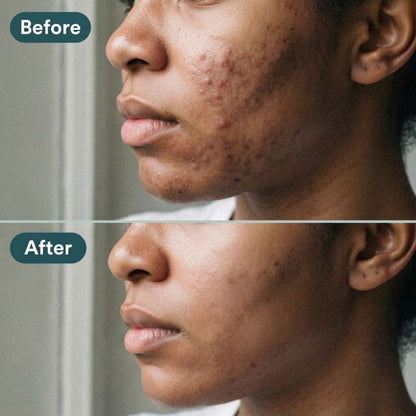 PCOS Balance+ Hormonal balance, regular cycles, clear skin